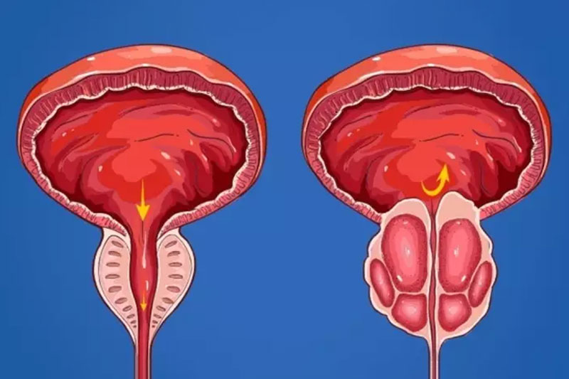 بزرگی خوش خیم پروستات (BPH)