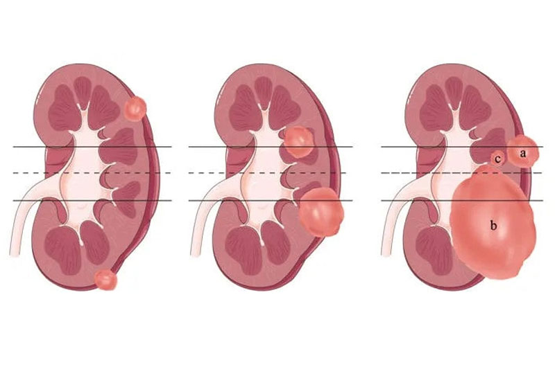 Nephrectomy