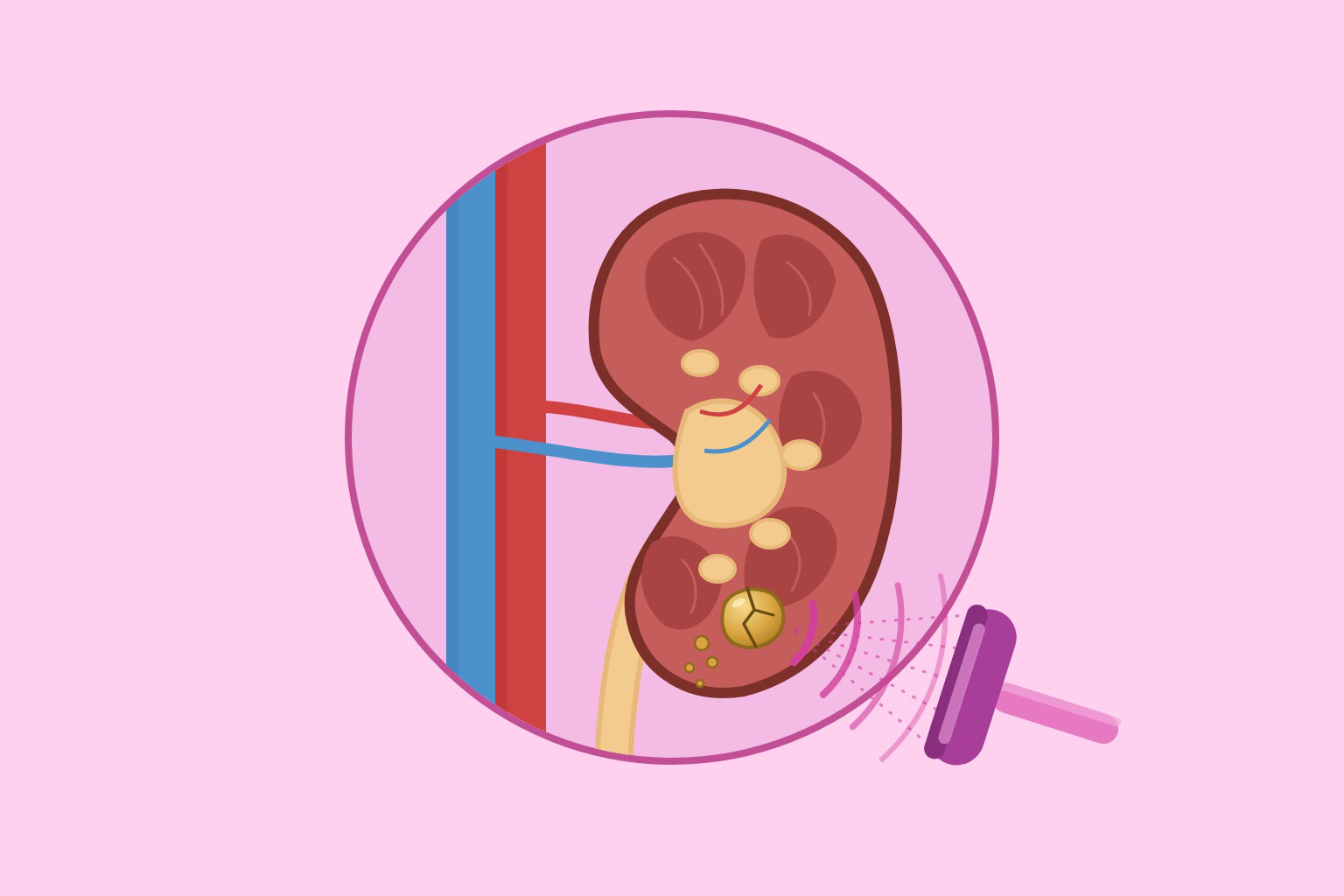 Lithotripsy
